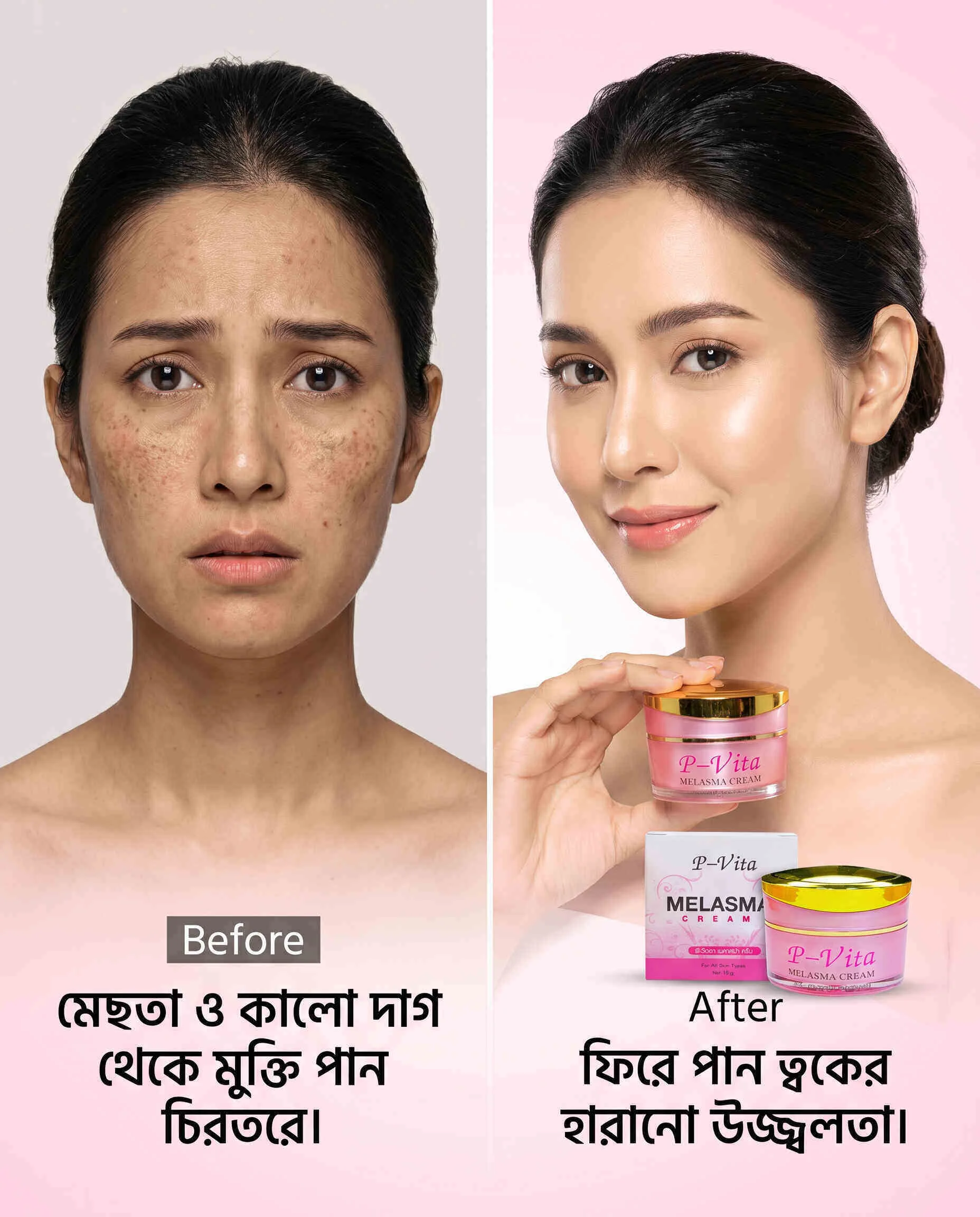 P Vita Melasma Mesta Whitening Cream -10 gm (Thailand)